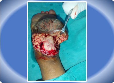 LOWER LIMB INJURY